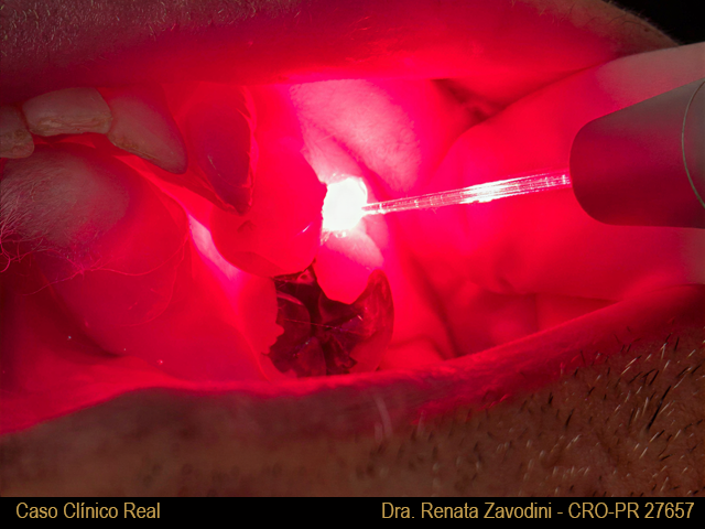 Tratamento periodontal